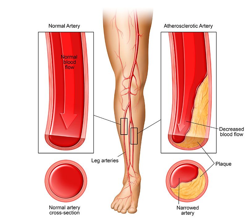 Peripheral Artery Disease