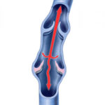 varicose vein management - bad vein flow