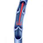 varicose vein management - good vein flow